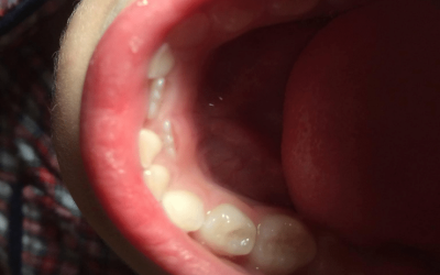 Your Child Has Shark Teeth, Should You be Concerned?