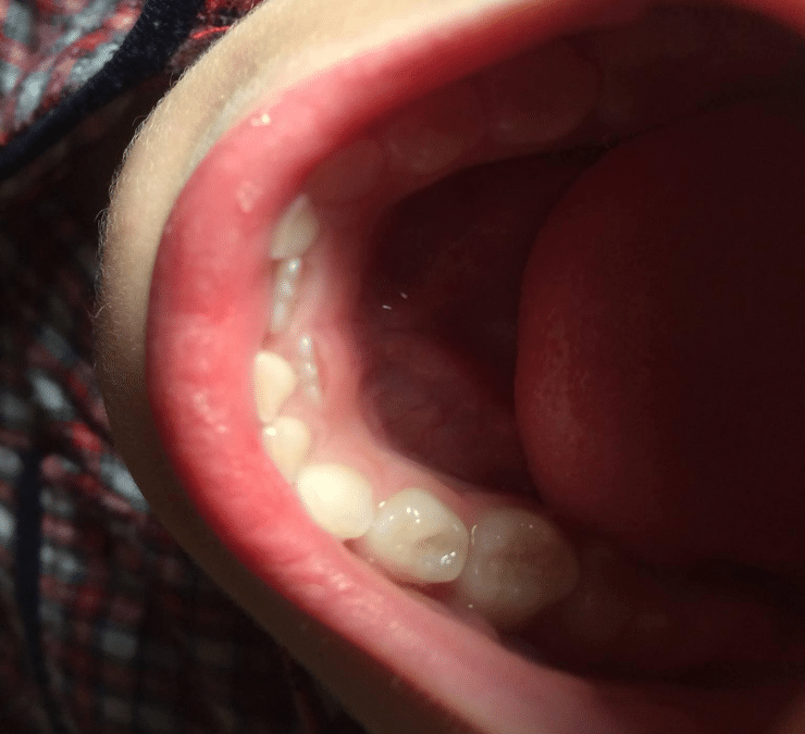 Your Child Has Shark Teeth, Should You be Concerned?