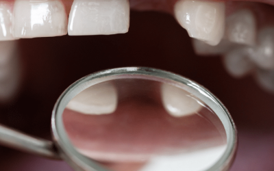 Why Replacing Lost Teeth Is Important