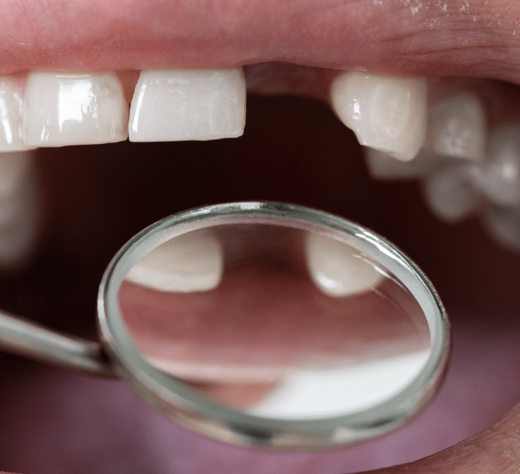 Why Replacing Lost Teeth Is Important