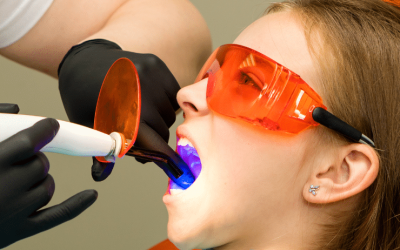 Dental Sealants: Everything You Need to Know