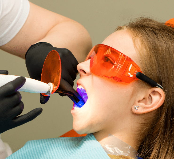 Dental Sealants: Everything You Need to Know