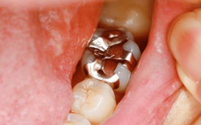 When Should Silver Fillings Be Replaced?