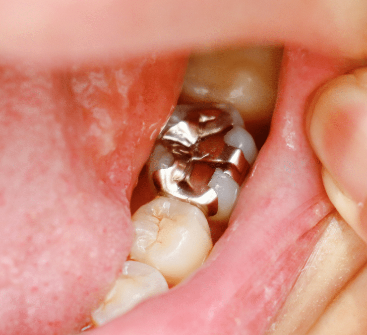 When Should Silver Fillings Be Replaced?